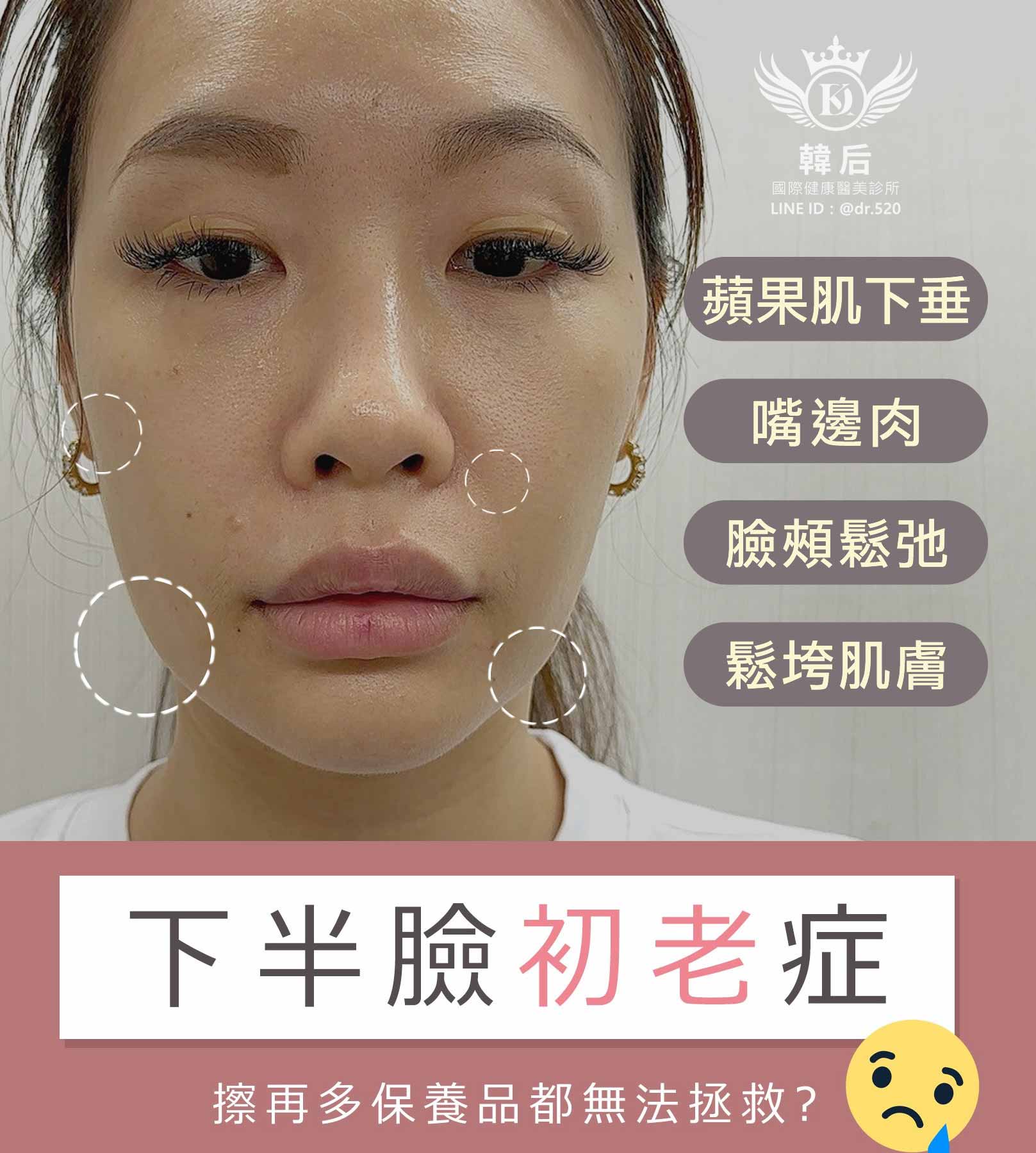 韓后醫美 十倍雙線音波 雙線音波 10THERA 舞蹈老師 Angel天使老師 真實案例