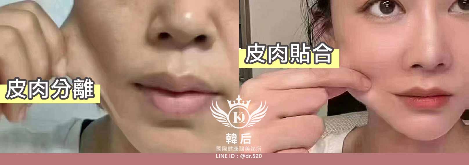 韓后醫美 2024明星閃耀款,十倍雙線音波 10THERA 雙線音波 2Line HIFU、10 Thera、雙倍美感、雙倍奇蹟、韓國巨星 明世彬代言。