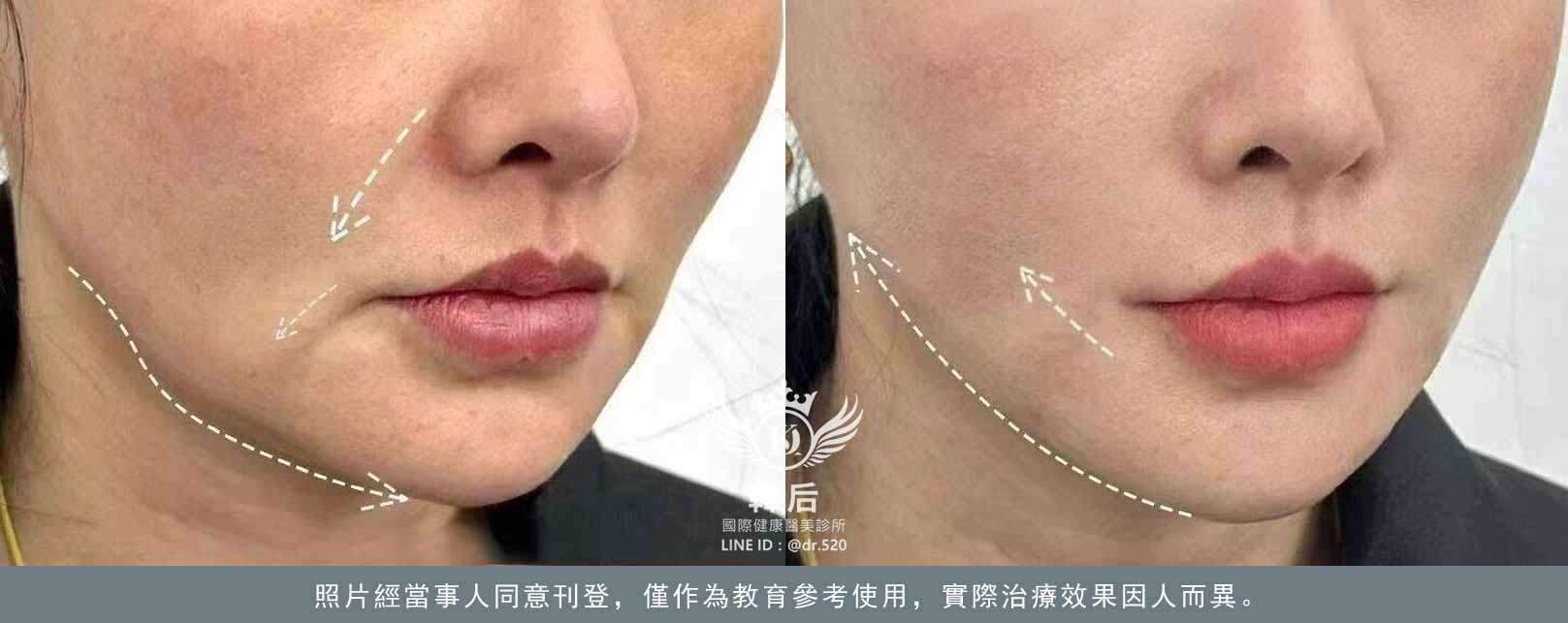 韓后醫美 十倍雙線音波 雙線音波 10THERA 素人真實案例