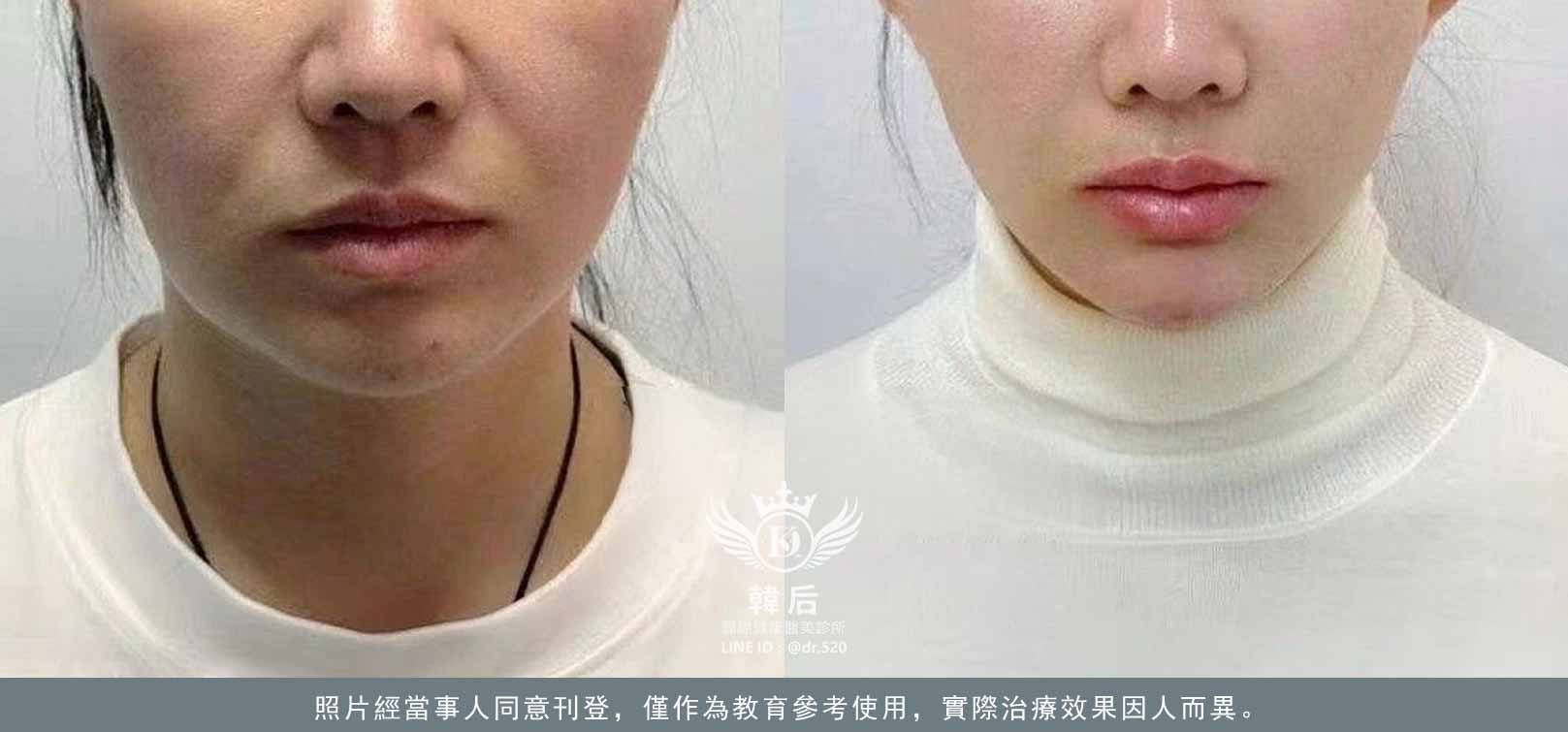 韓后醫美 十倍雙線音波 雙線音波 10THERA 素人真實案例