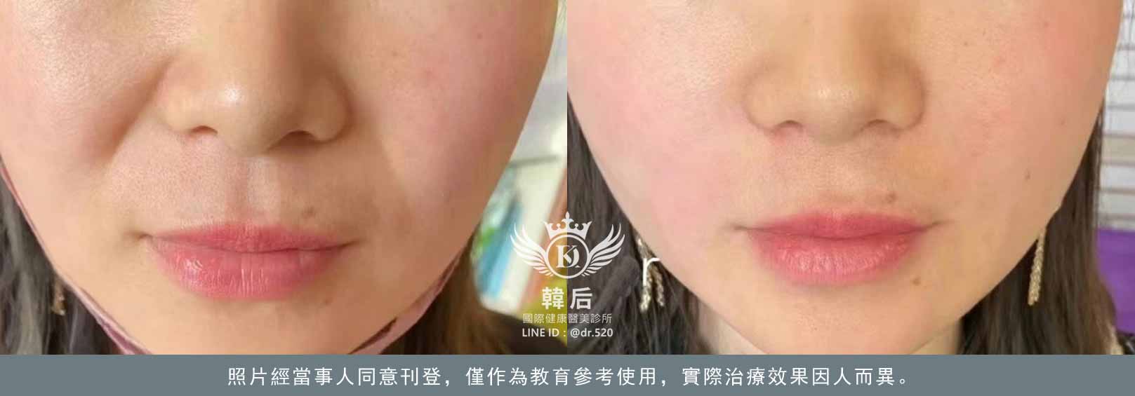 韓后醫美 十倍雙線音波 雙線音波 10THERA 素人真實案例