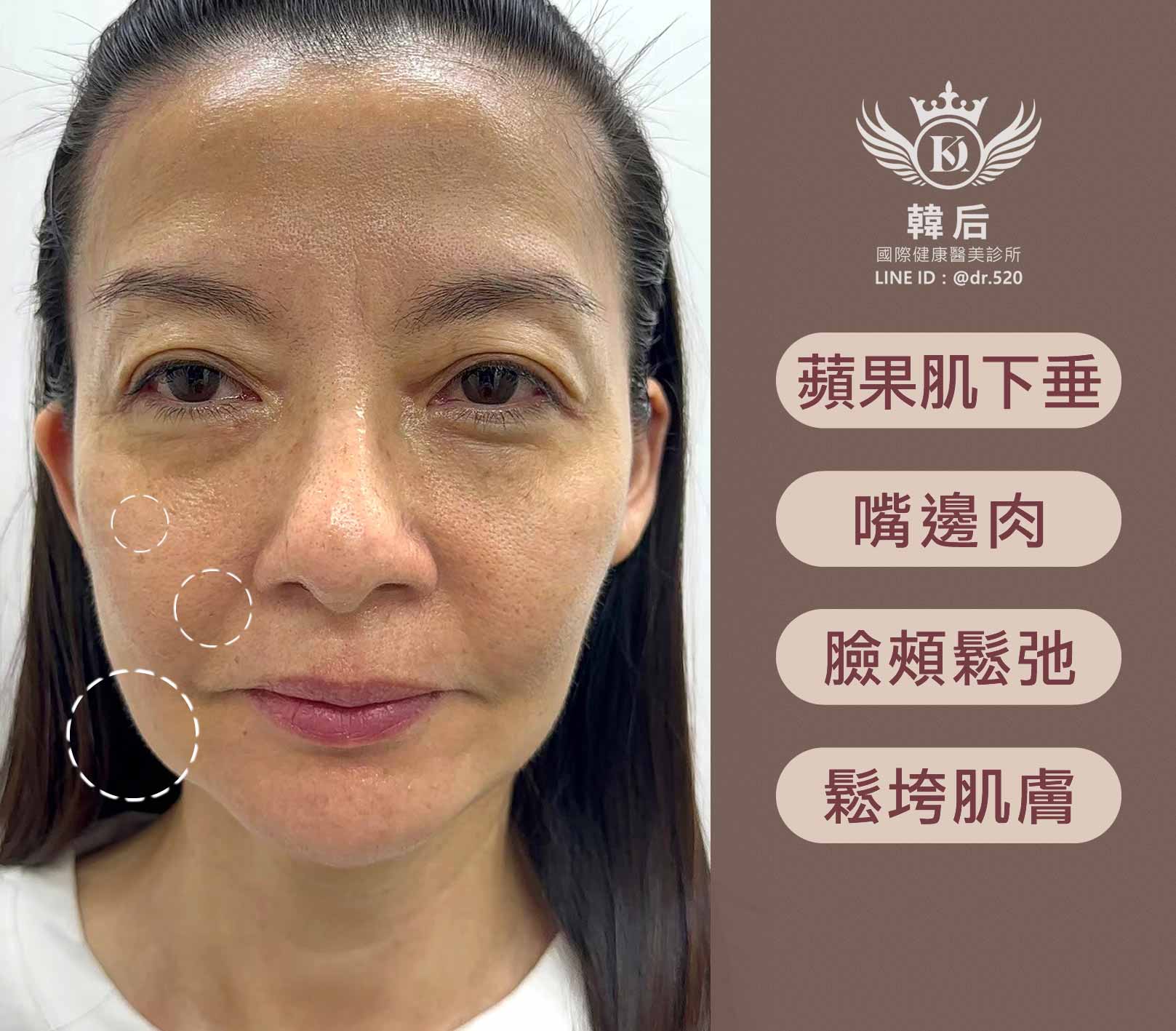 韓后醫美 十倍雙線音波 雙線音波 10THERA 最美觀音 演員陳若萍 真實案例