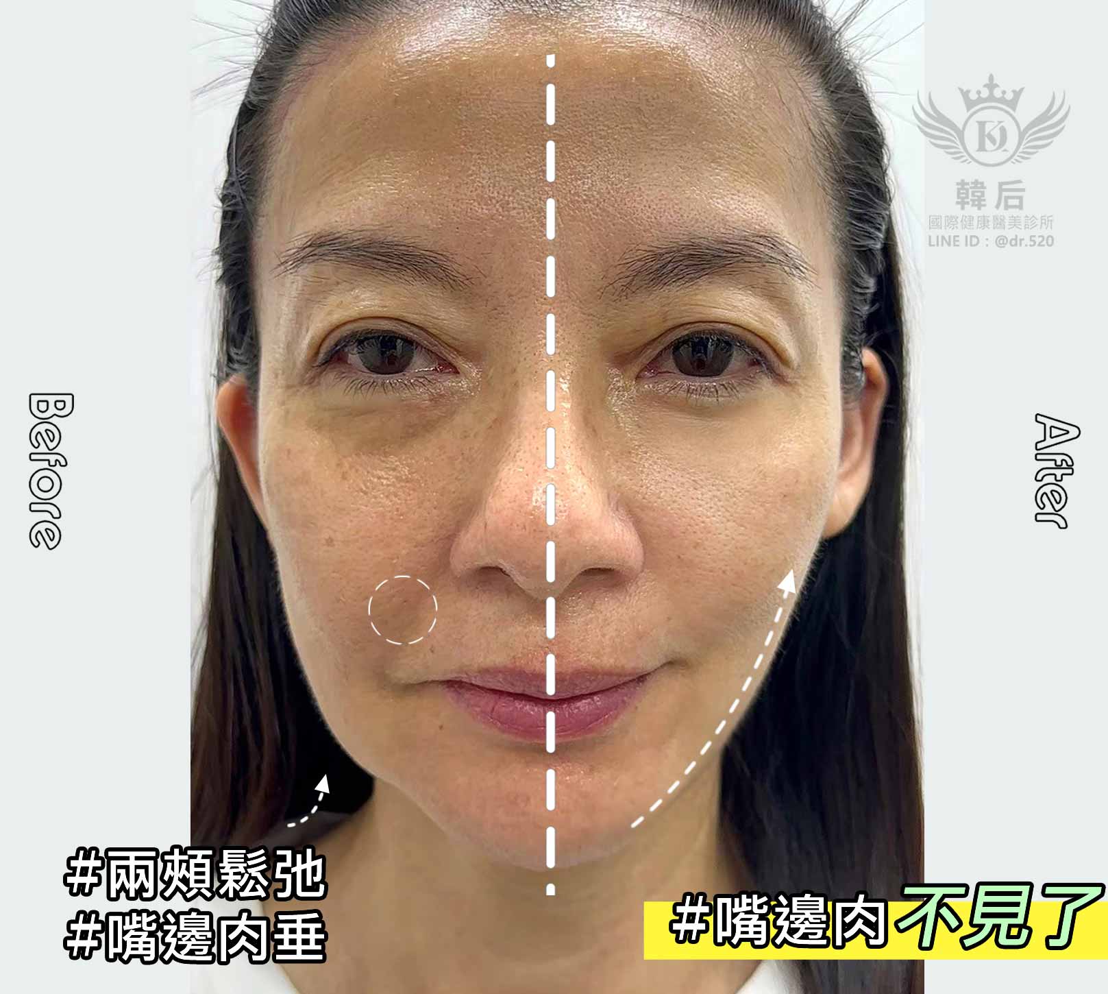 韓后醫美 十倍雙線音波 雙線音波 10THERA 最美觀音 演員陳若萍 真實案例