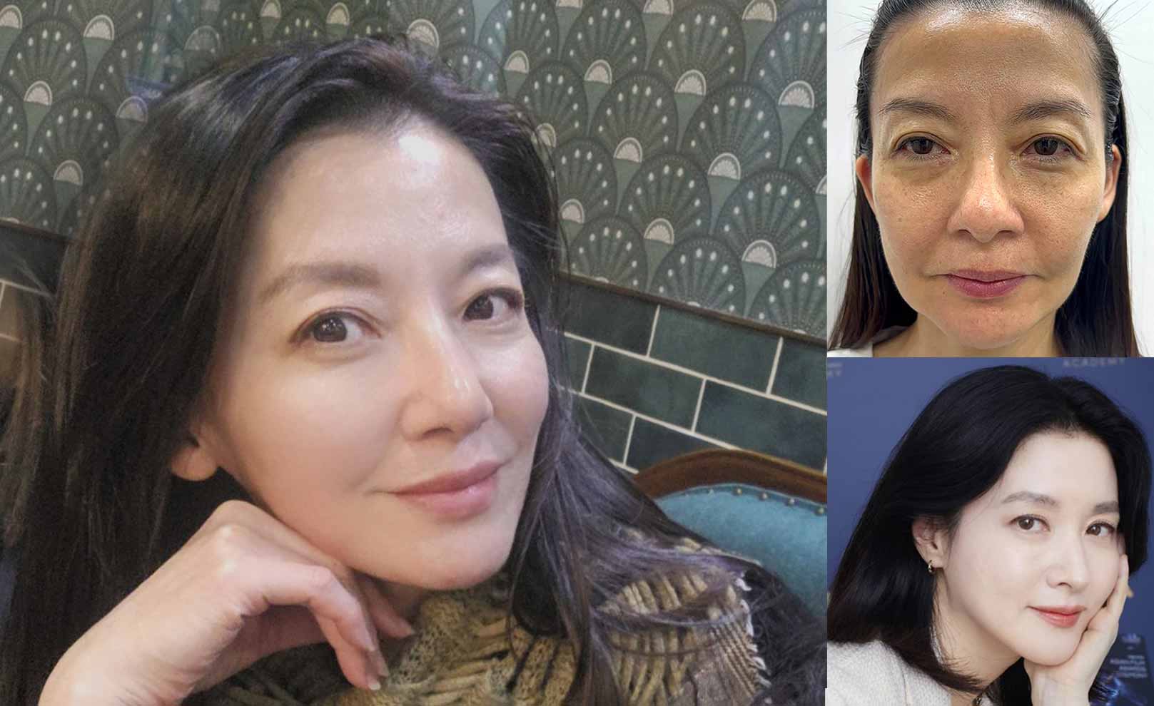 韓后醫美 十倍雙線音波 雙線音波 10THERA 最美觀音 演員陳若萍 打造台版李英愛 真實案例