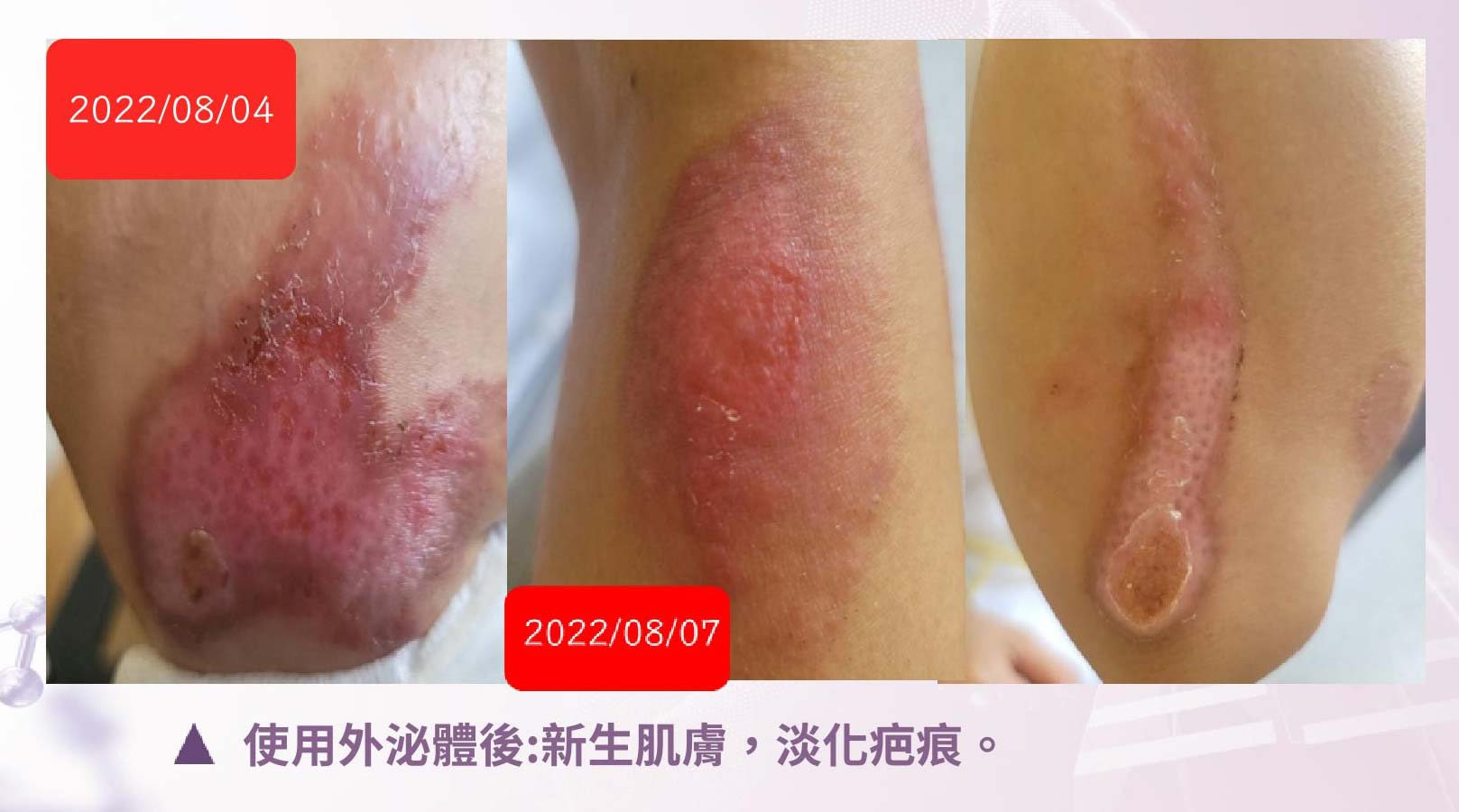 韓后醫美 愛法洛 ÉVOL 韓國外泌體 皮膚
