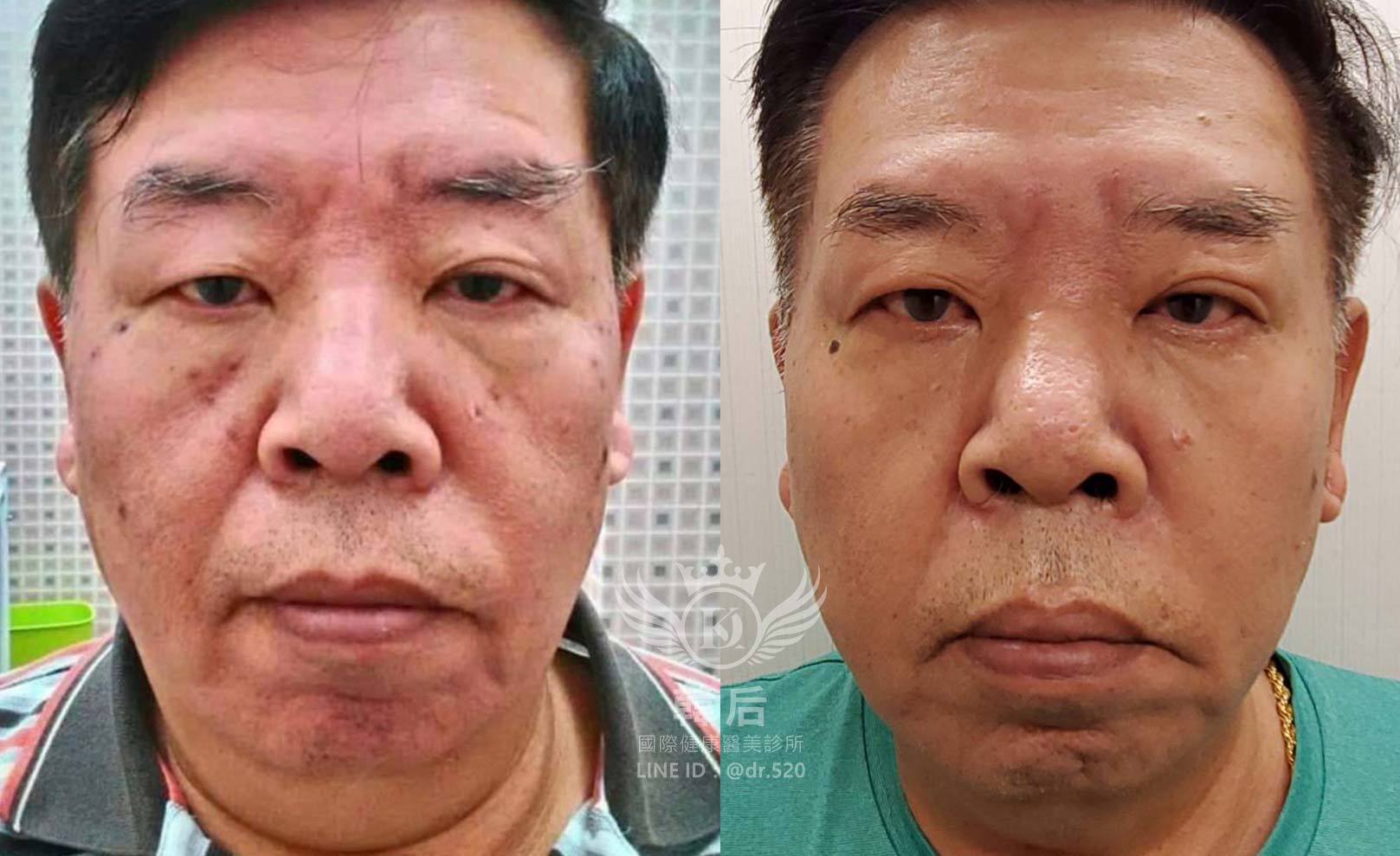 韓后醫美,韓國中胚層淡斑,素人真實案例