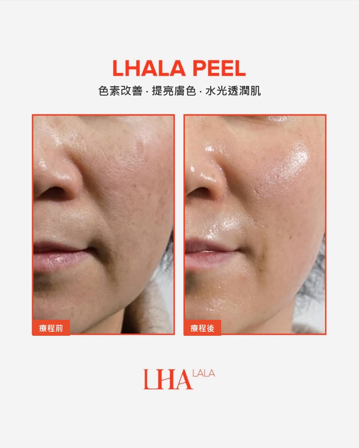 LHALA Peel 504 韓國 H2MEDI 官方 Before After 案例 改善色素 提亮膚色 水光鏡膜肌