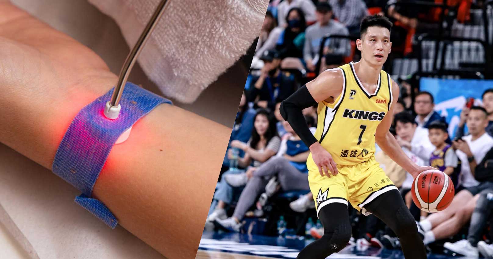 林書豪為何被禁賽？ILIB靜脈雷射是什麼？新北國王球星林書豪因誤用違反WADA規定之「靜脈雷射」療法。生化雷射又稱氦氖雷射、低能量生化雷射、靜脈雷射或ILIB(Intravenous　Laser Irradiation of Blood)，氦氖雷射是屬於物理性的一種，是用632.8波長6mW以下的低能量紅色生化雷射光，產生光化學效應，活化血球對於血液中循環的血球與各種細胞有改善功能、促進代謝、清除自由基。利用光纖將低能量的雷射導入血液後，光能會轉化成生物能量，使紅血球的攜氧能力增加，新陳代謝會增強，白血球及其他免疫相關的機能也會改善，不論是做為輔助治療、正規醫療或是保健抗衰老的預防醫療來說，都有不錯的效果。