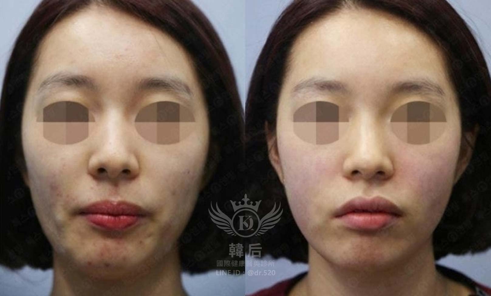 猛健樂臉,瘦瘦針臉,素人真實案例,膠原蛋白填充,玻尿酸填充,電波拉提,音波拉提,韓后醫美