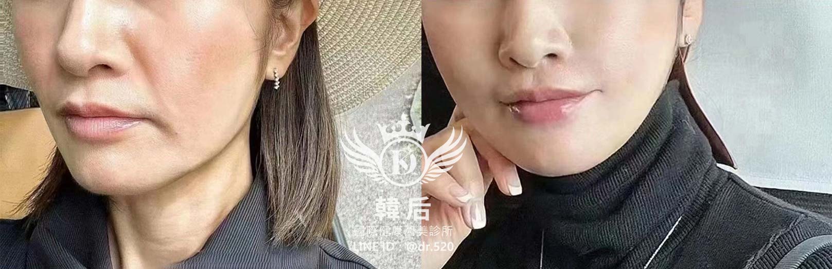 猛健樂臉,瘦瘦針臉,素人真實案例,膠原蛋白填充,玻尿酸填充,電波拉提,音波拉提,韓后醫美