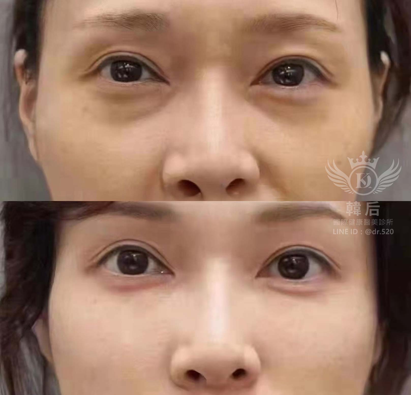 猛健樂臉,瘦瘦針臉,素人真實案例,膠原蛋白填充,玻尿酸填充,電波拉提,音波拉提,韓后醫美