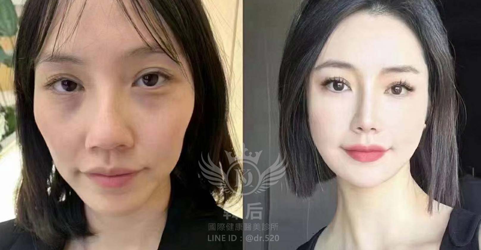 猛健樂臉,瘦瘦針臉,素人真實案例,膠原蛋白填充,玻尿酸填充,電波拉提,音波拉提,韓后醫美