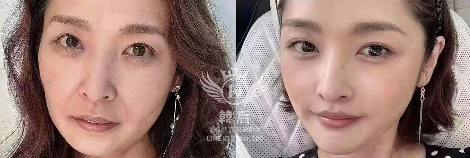 猛健樂臉,瘦瘦針臉,素人真實案例,膠原蛋白填充,玻尿酸填充,電波拉提,音波拉提,韓后醫美