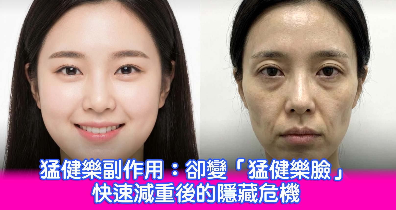 什麼是「猛健樂臉」、「瘦瘦針臉」？猛健樂副作用：卻變「猛健樂臉」？快速減重後的隱藏危機！韓后醫美