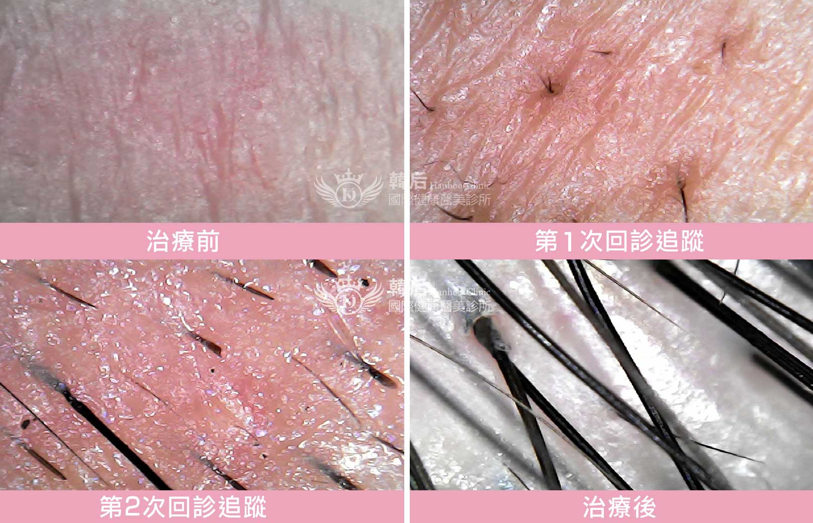 韓后醫美 Exosomes 韓國外泌體 毛髮再生 真實案例