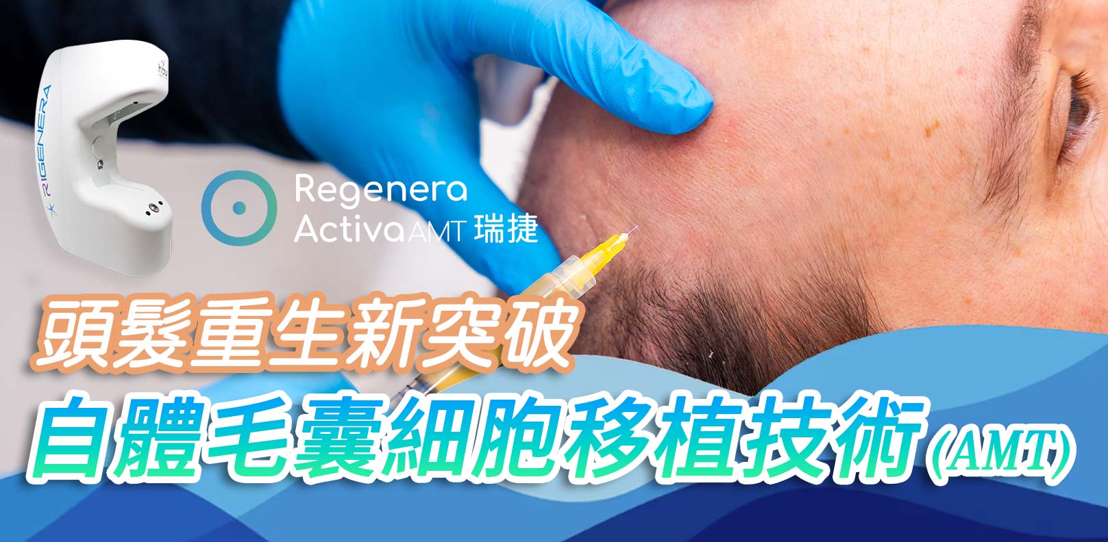 頭髮重生新突破:RA自體毛囊細胞移植技術(Autologous Micrografting Technology;AMT),簡稱AMT治療。韓后醫美