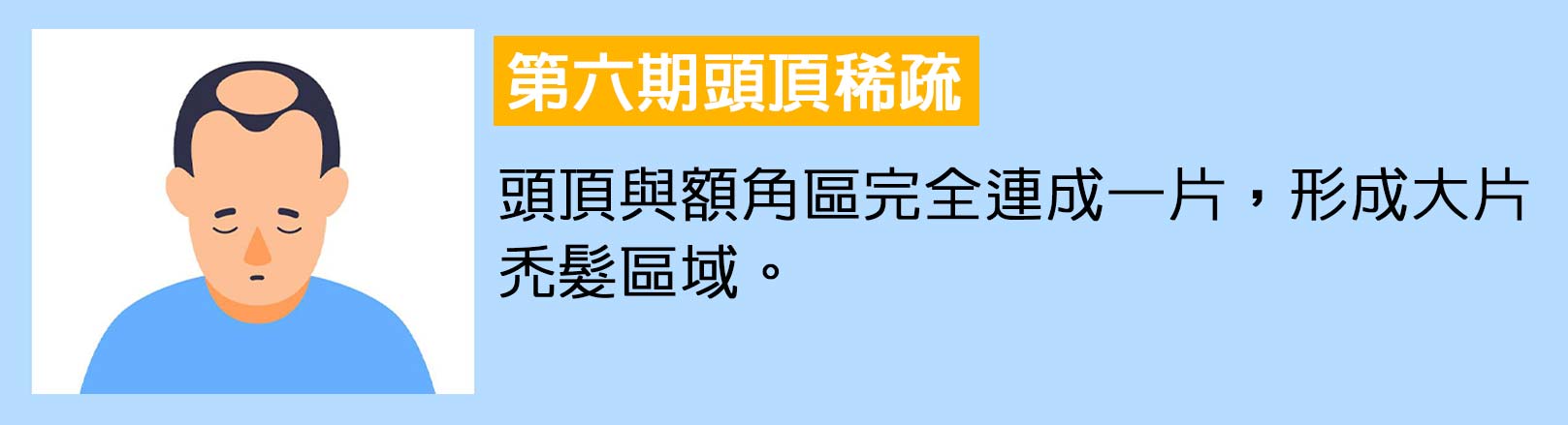 第六期頭頂稀疏：頭頂與額角區完全連成一片，形成大片禿髮區域。韓后醫美