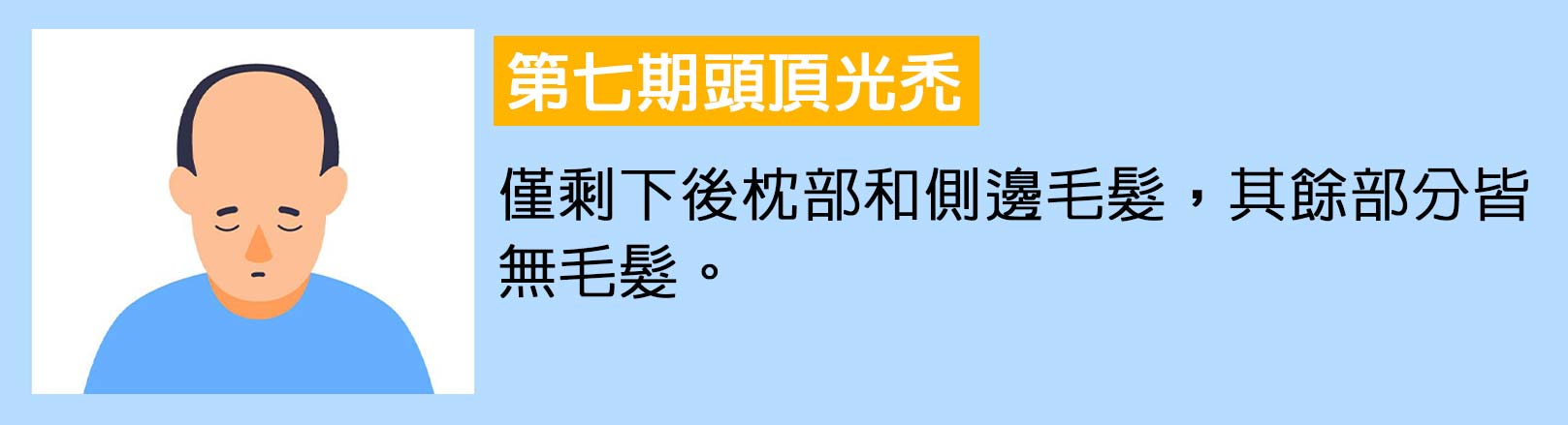 第七期頭頂光禿：僅剩下後枕部和側邊毛髮，其餘部分皆無毛髮。韓后醫美