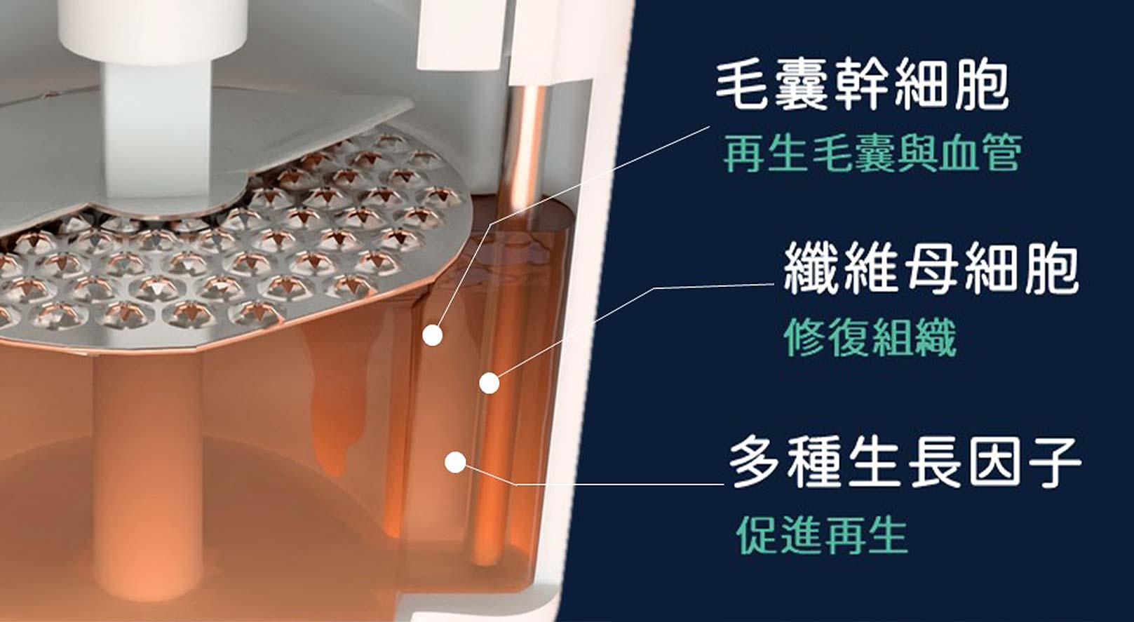 RA自體毛囊細胞移植技術(AMT)細胞懸浮液：1.毛囊幹細胞-再生毛囊與血管。2.纖維母細胞-修復組織。3.多種生長因子-促進再生。韓后醫美