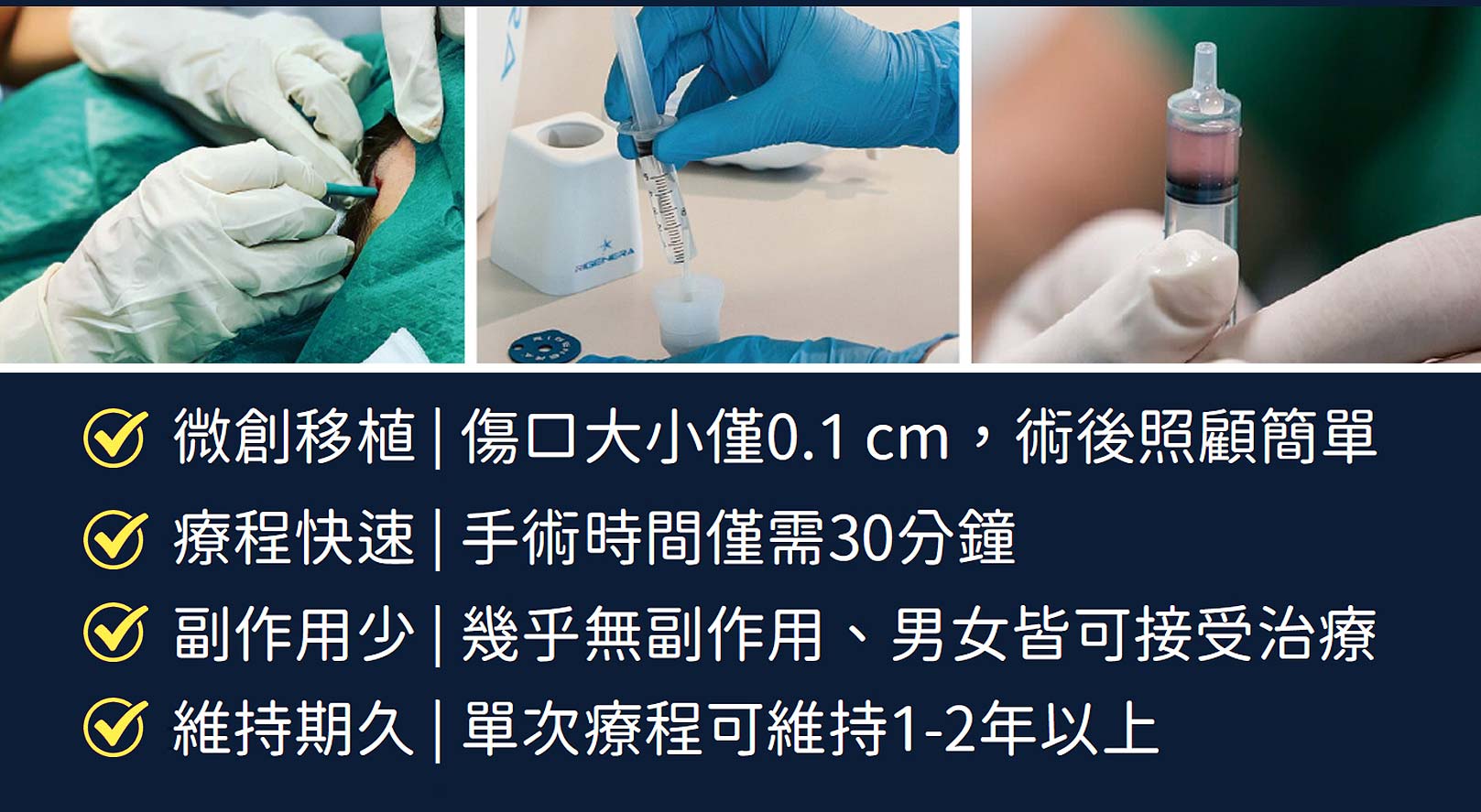 微創移植：傷口大小僅0.1cm，術後照顧簡單。療程快速：手術時間僅需30分鐘。副作用少：幾乎無副作用、男女皆可接受治療。維持期久：單次療程可維持1-2年以上。韓后醫美