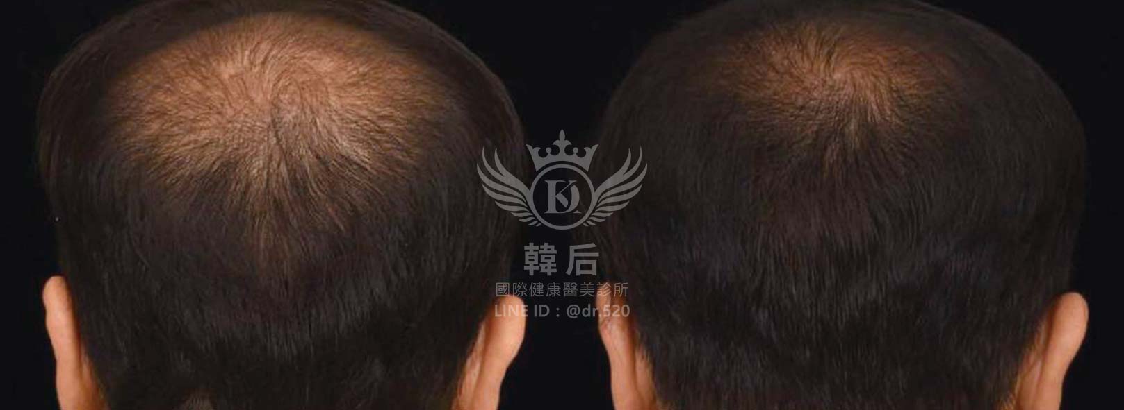 RA自體毛囊細胞移植技術(AMT),韓后醫美,Exosomes,韓國外泌體,毛髮再生,真實案例