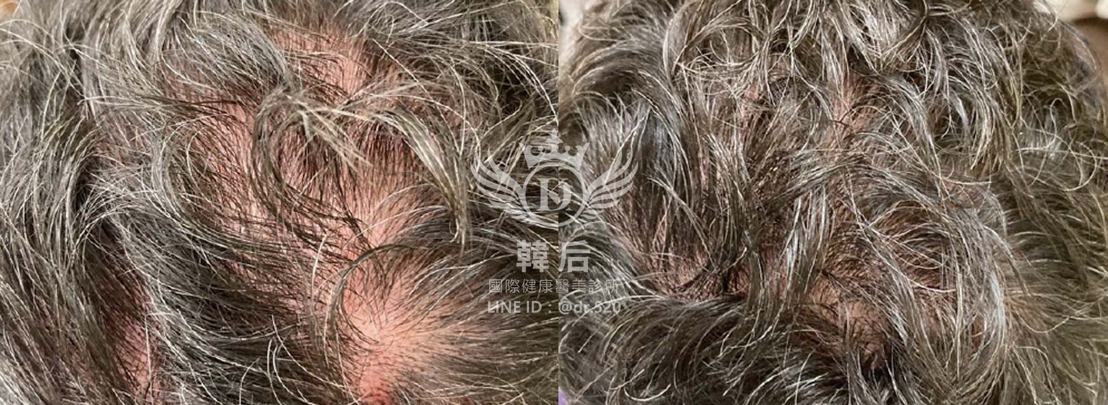 RA自體毛囊細胞移植技術(AMT),韓后醫美,Exosomes,韓國外泌體,毛髮再生,真實案例