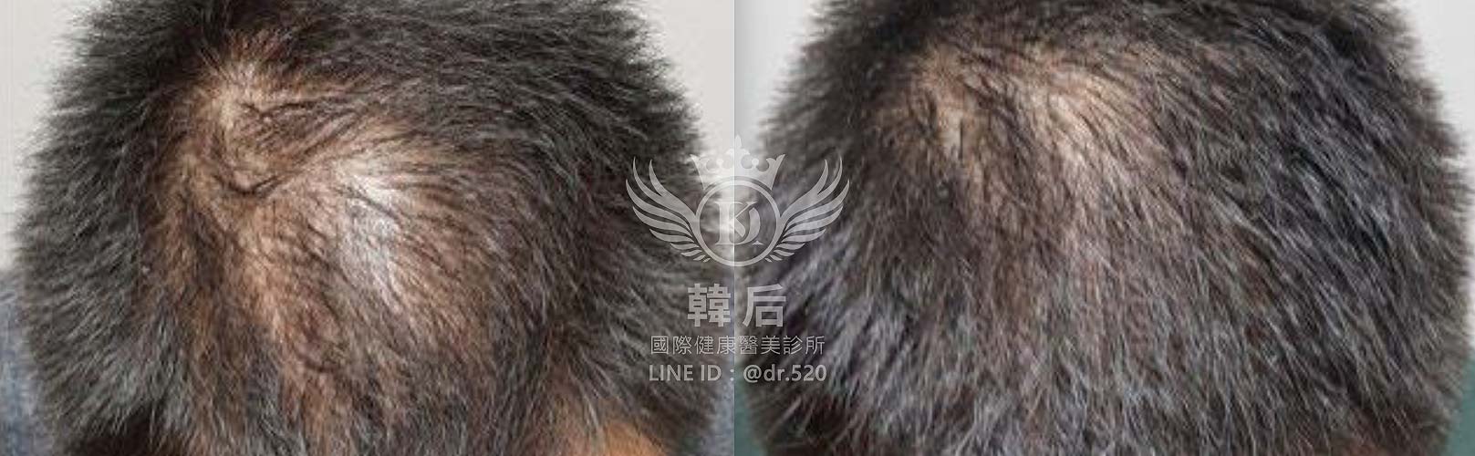 RA自體毛囊細胞移植技術(AMT),韓后醫美,Exosomes,韓國外泌體,毛髮再生,真實案例