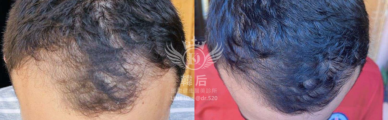 RA自體毛囊細胞移植技術(AMT),韓后醫美,Exosomes,韓國外泌體,毛髮再生,真實案例