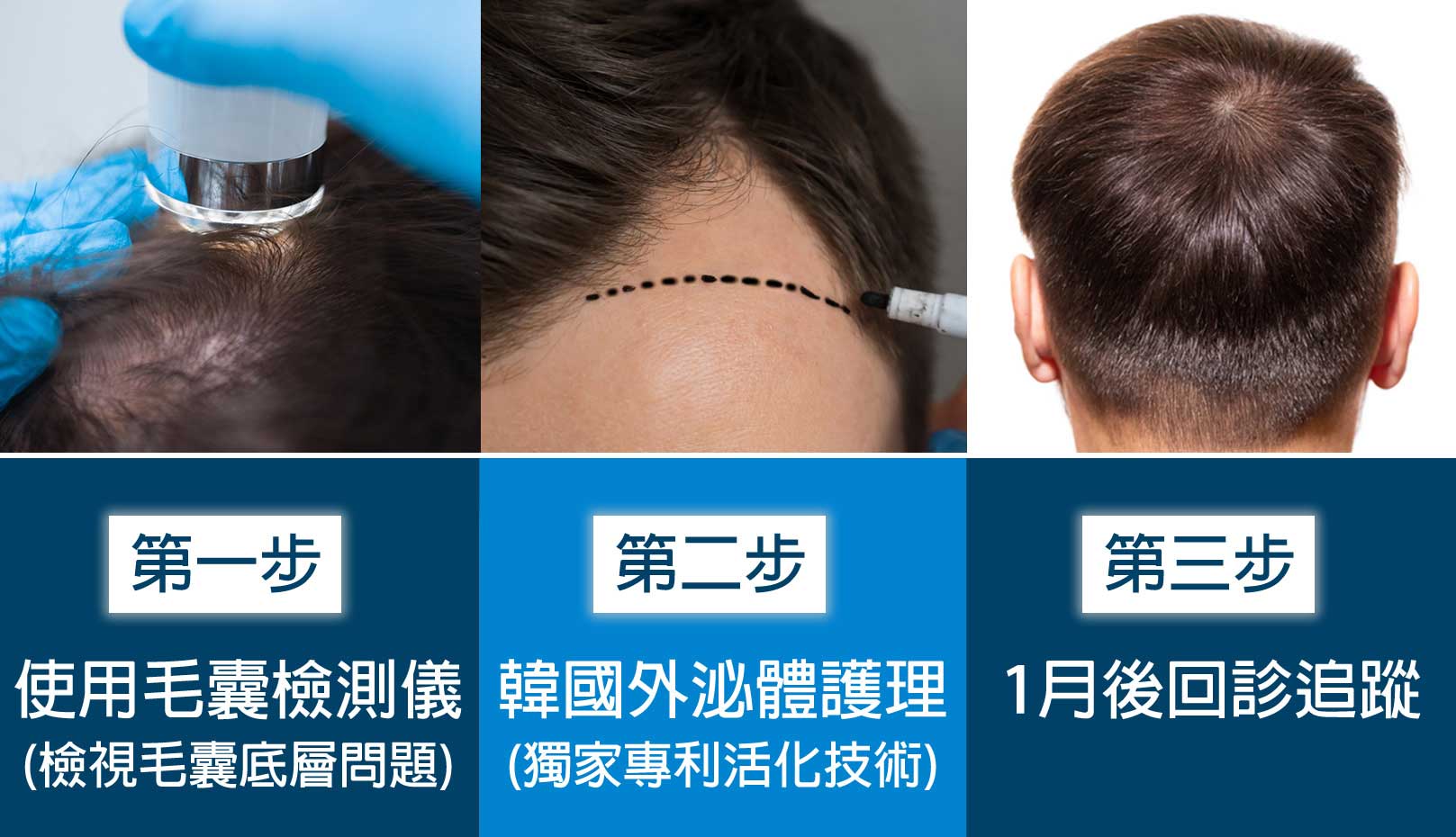 韓后醫美 Exosomes 韓國外泌體 健髮流程：第一步 使用毛囊檢測儀(檢視毛囊底層問題) > 第二步 韓國外泌體護理 > 第三步 1月後追蹤