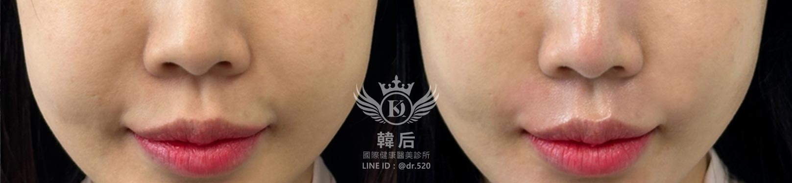 韓后醫美,COOLFASE無痛冷凍拉皮,消除法令紋,改造前後,素人真實案例