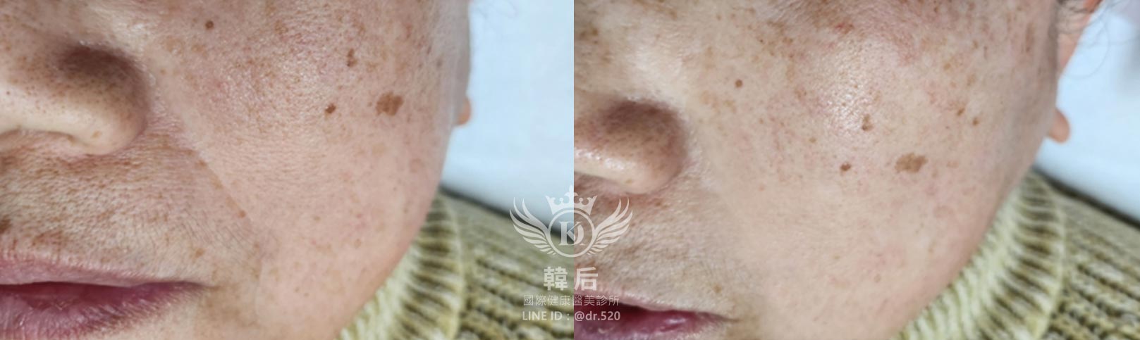 韓后醫美,COOLFASE無痛冷凍拉皮,消除法令紋,改造前後,素人真實案例