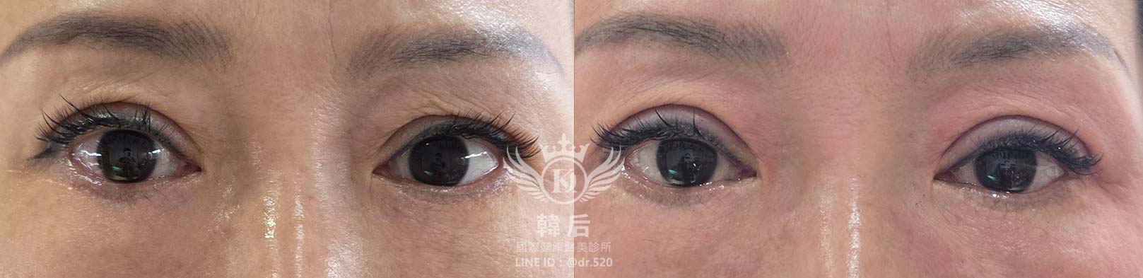 韓后醫美 提可塑 Tixel 眼部 除皺 雙眼皮 素人真實案例