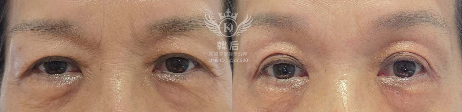 韓后醫美 提可塑 Tixel 眼部 除皺 雙眼皮 素人真實案例