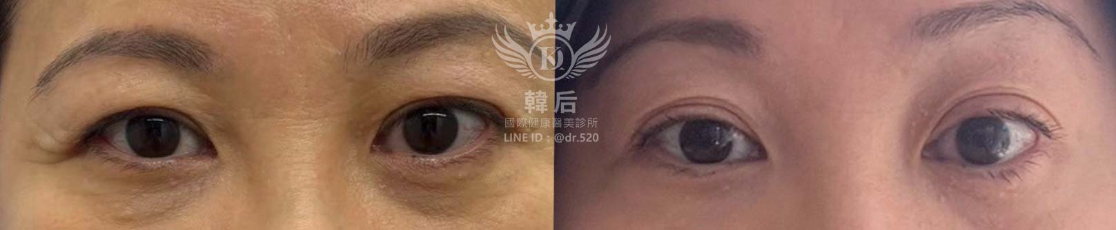 韓后醫美 提可塑 Tixel 眼部 除皺 雙眼皮 素人真實案例