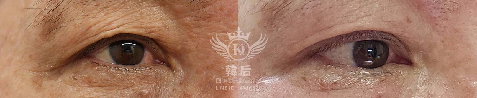韓后醫美 提可塑 Tixel 眼部 除皺 雙眼皮 素人真實案例