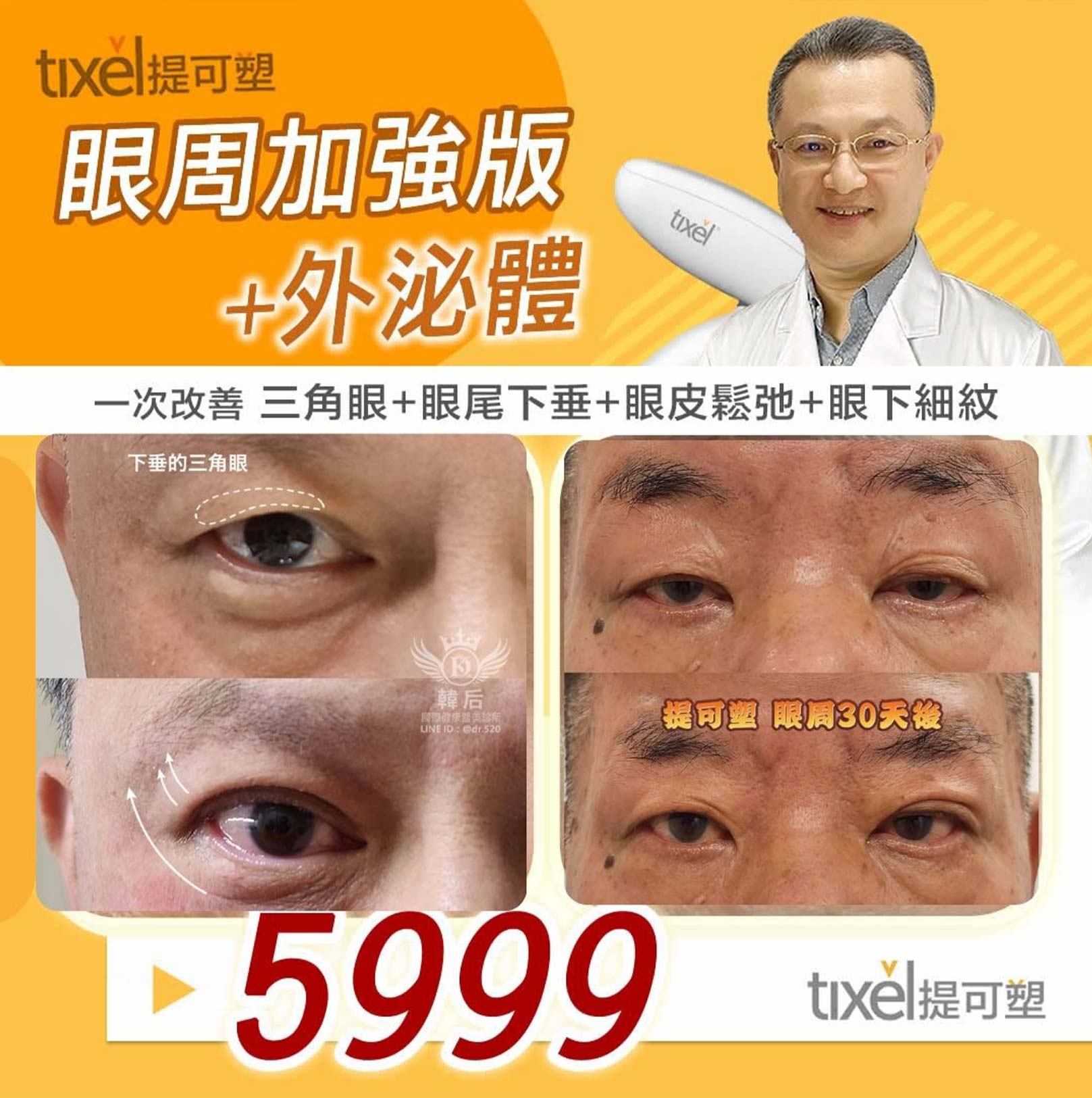 韓后醫美 提可塑 Tixel