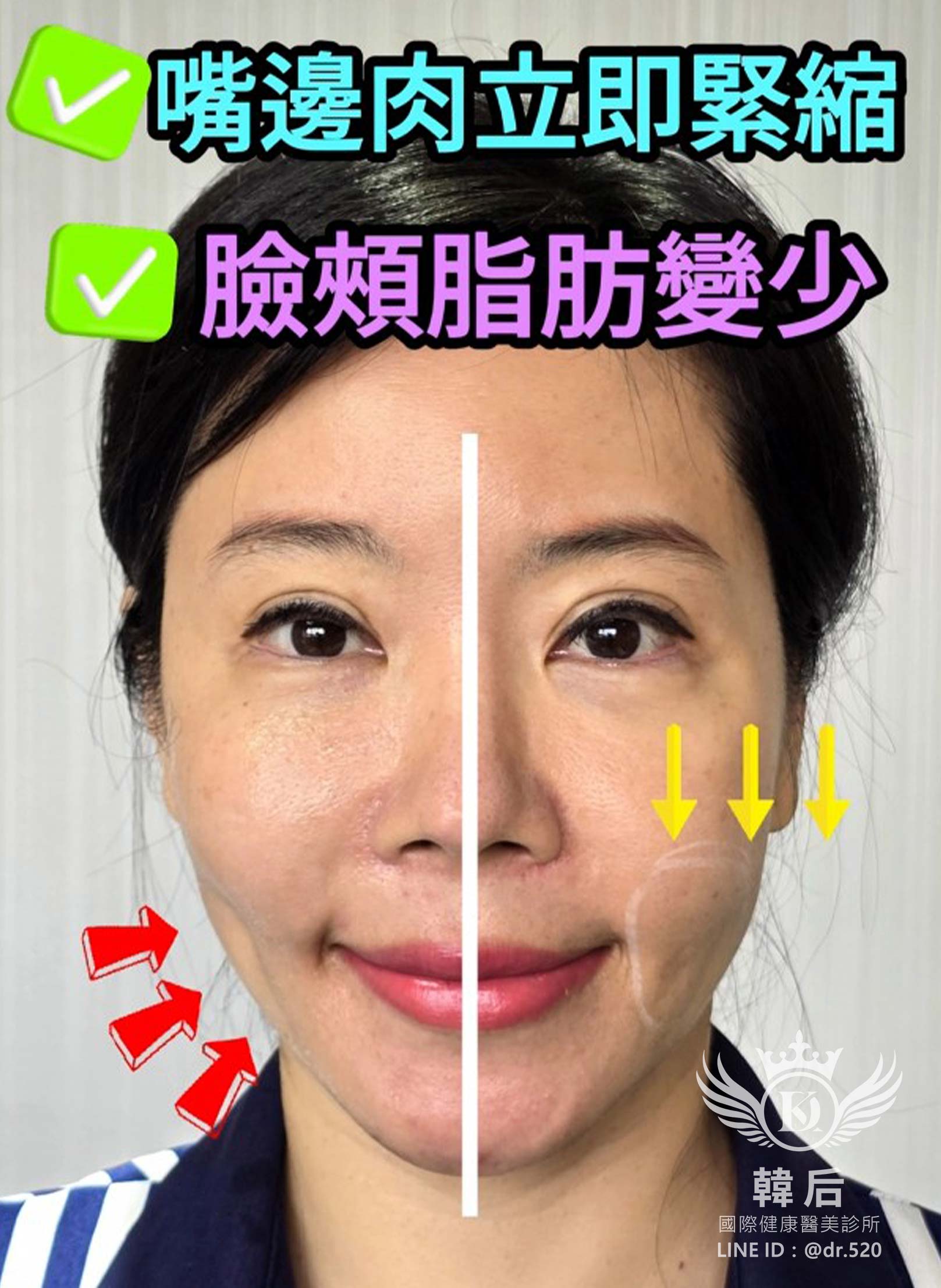 韓后醫美,皇后電波CoolFase®,無痛冷凍拉皮,消除嘴邊肉,雙頰下垂,韓后執行長,孔娜娜,韓國台灣醫美CEO,改造前後,真實案例