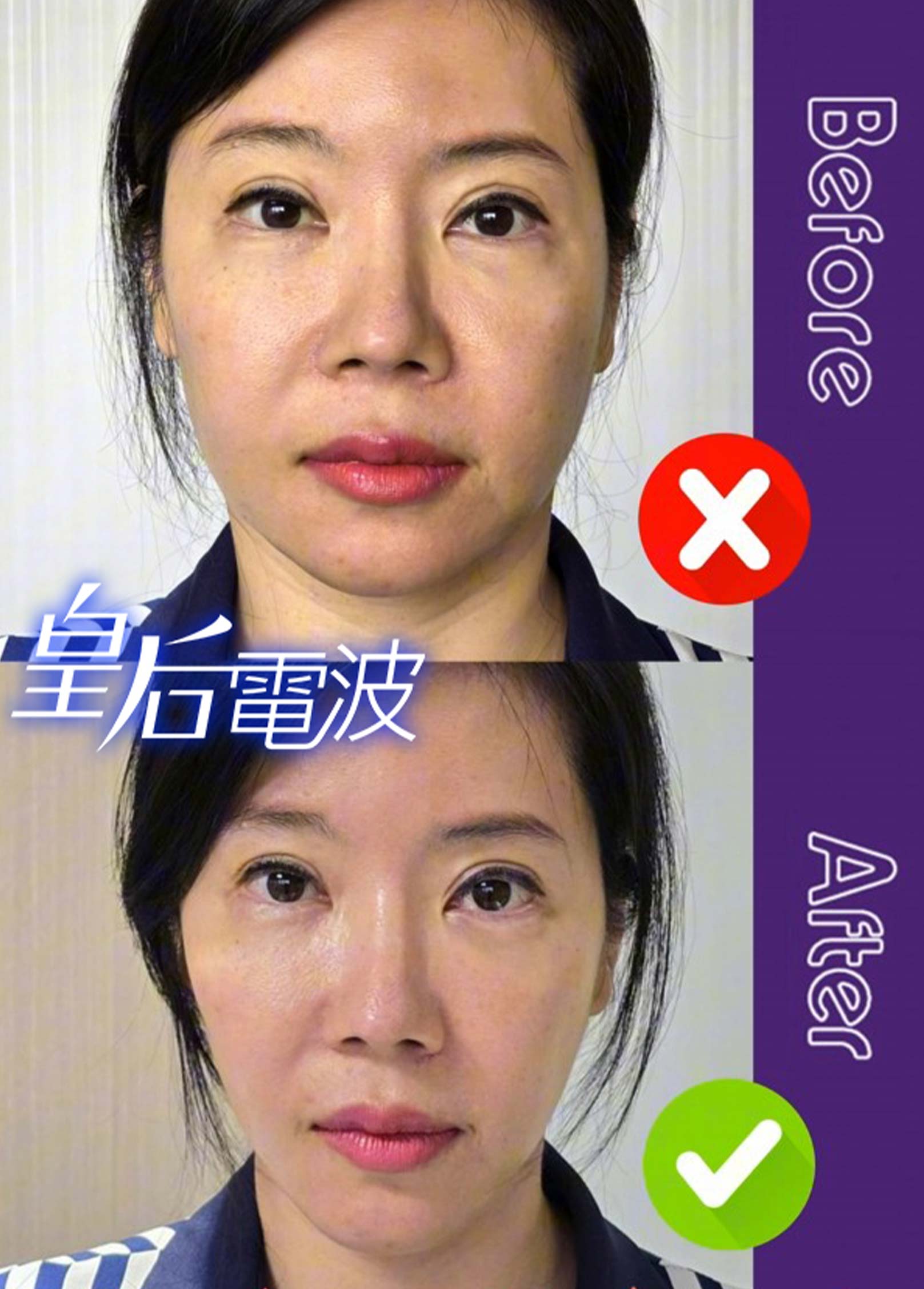 韓后醫美,皇后電波CoolFase®,無痛冷凍拉皮,消除嘴邊肉,雙頰下垂,韓后執行長,孔娜娜,韓國台灣醫美CEO,改造前後,真實案例