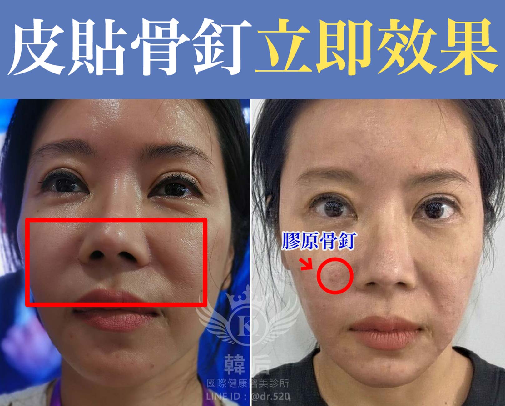 皮貼骨釘,膠原骨釘,臉部輪廓加壓固定復位，立即達到貼合筋膜骨相效果。醫美執行長,CEO,孔娜娜,皮貼骨,臉部打薄,韓后診所