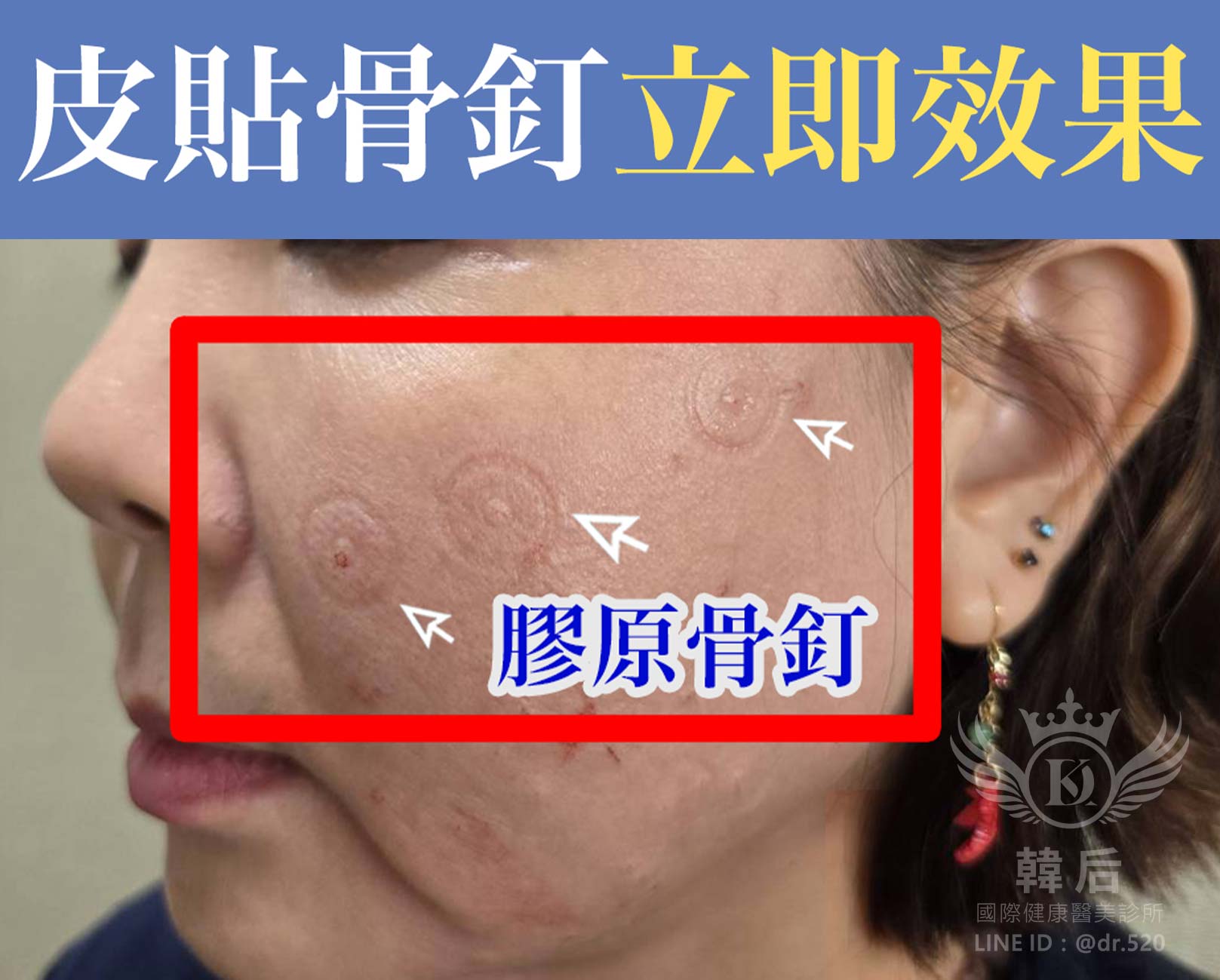 皮貼骨釘,膠原骨釘,臉部輪廓加壓固定復位，立即達到貼合筋膜骨相效果。皮貼骨,臉部打薄,韓后診所