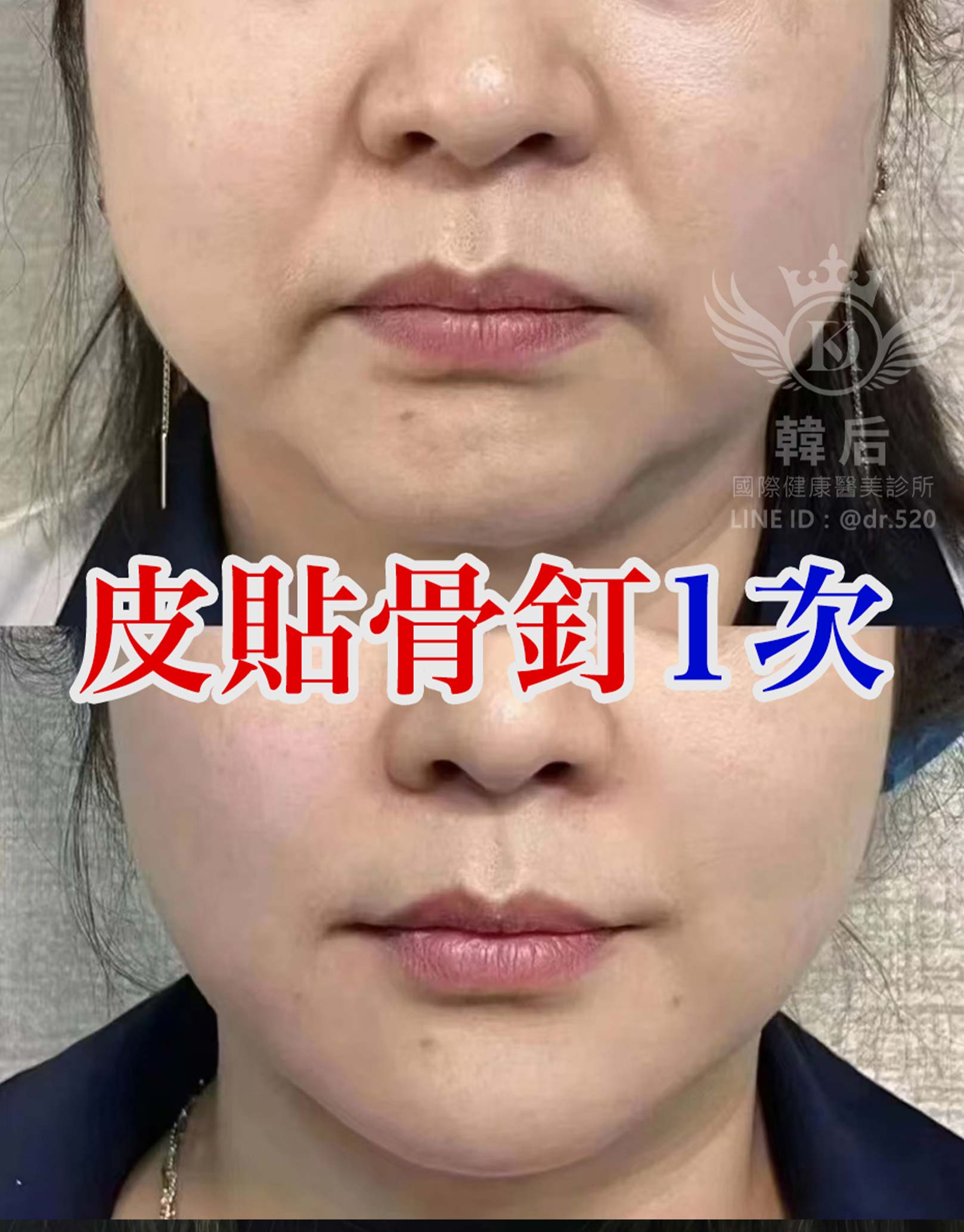 皮貼骨釘1次馬上改善。韓后醫美