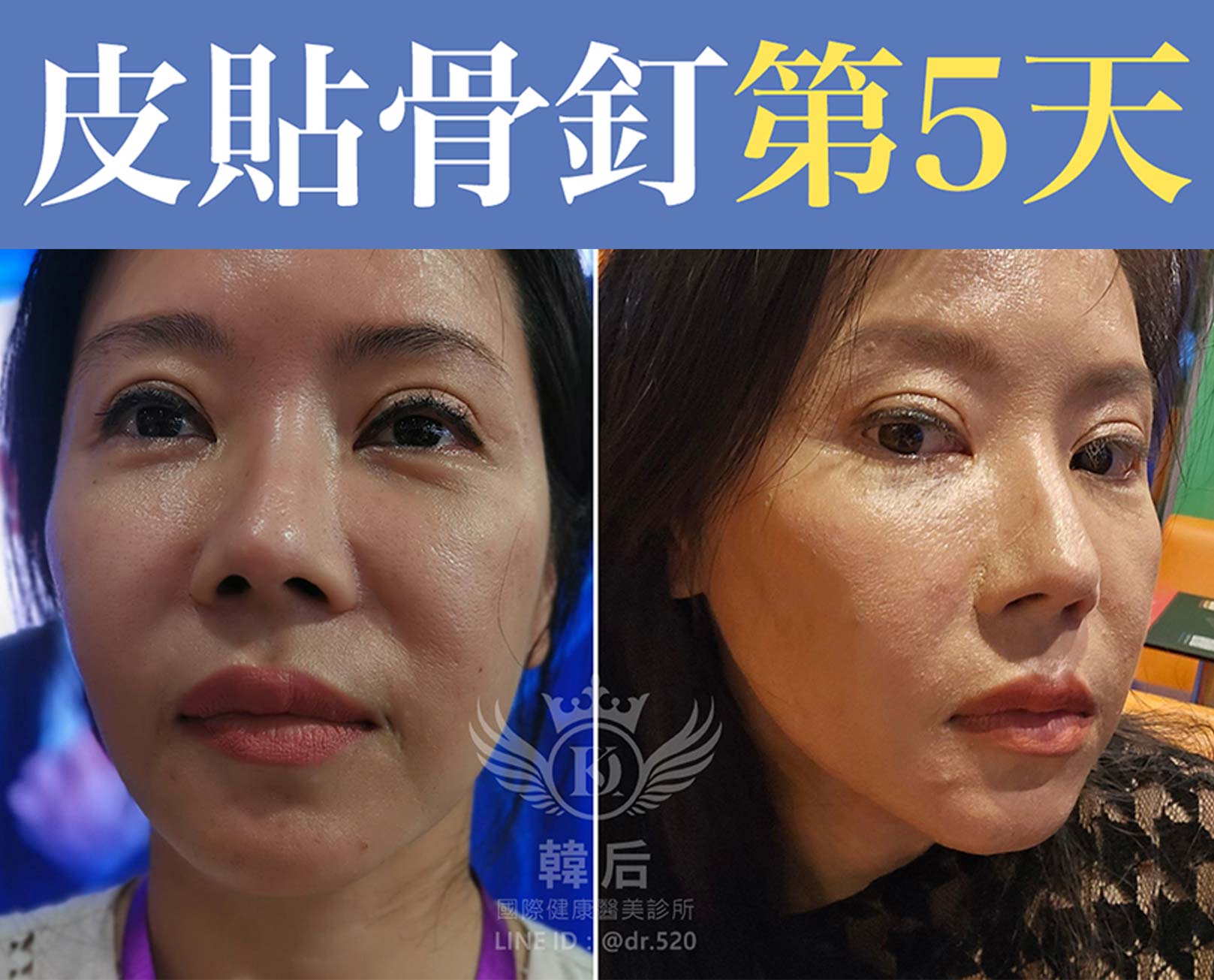 皮貼骨釘療程後第5天,拉提緊緻,時尚小臉。韓后醫美