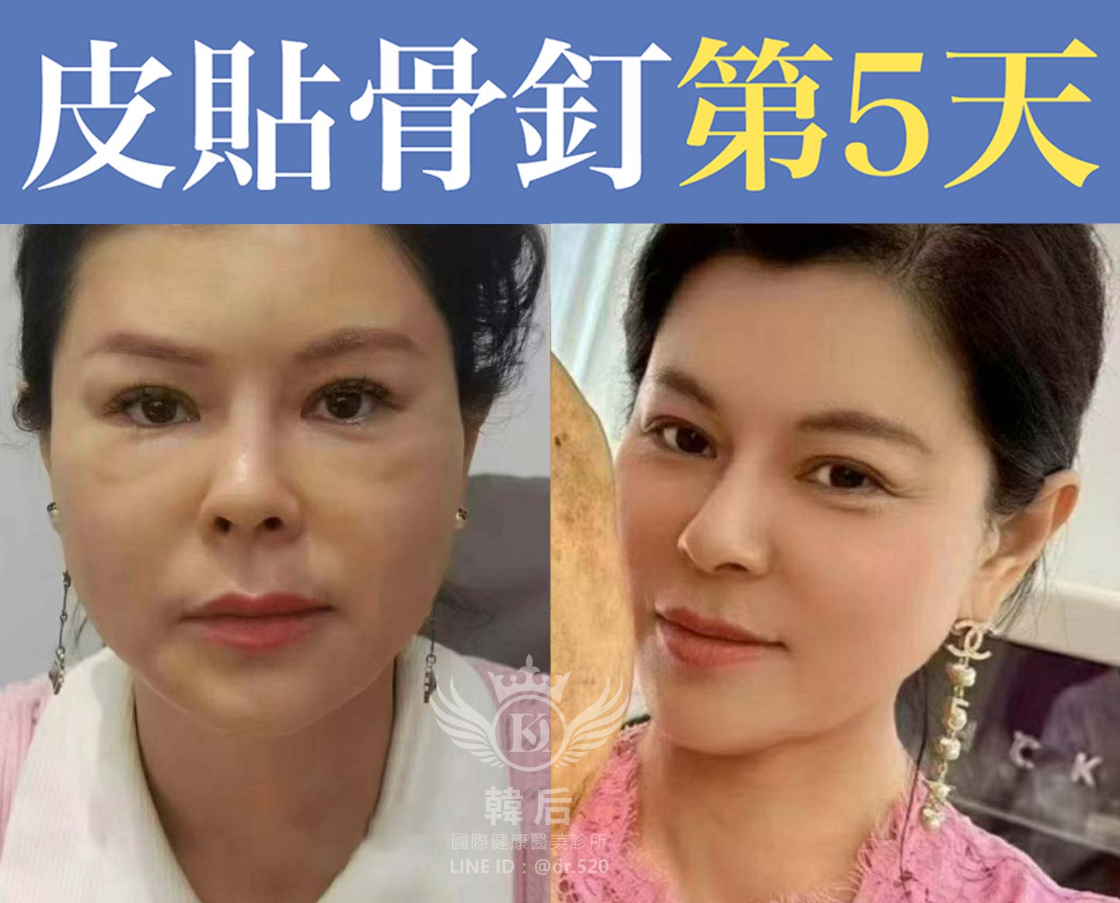 皮貼骨釘療程後第5天,拉提緊緻,時尚小臉。韓后醫美