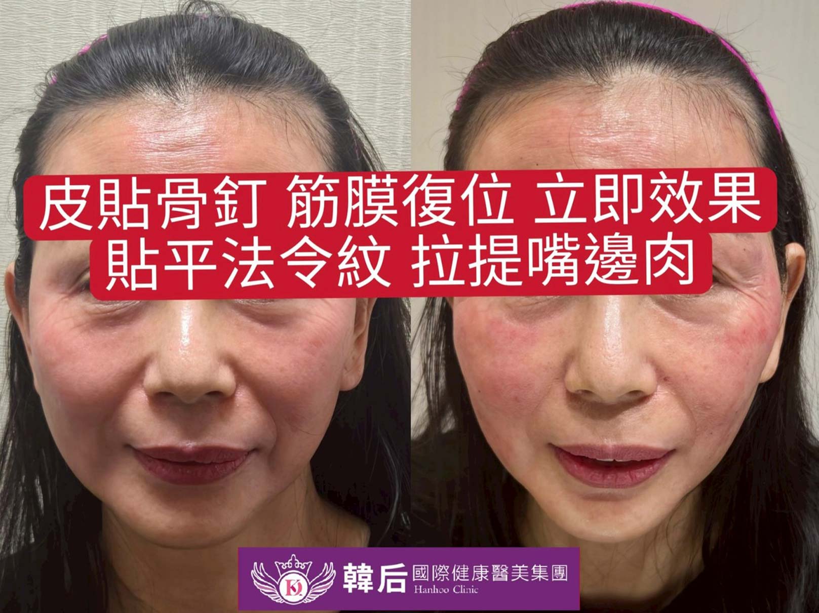 皮貼骨釘,筋膜復位,立即效果,貼平法令紋,拉提嘴邊肉,拉提緊緻,時尚小臉。韓后醫美