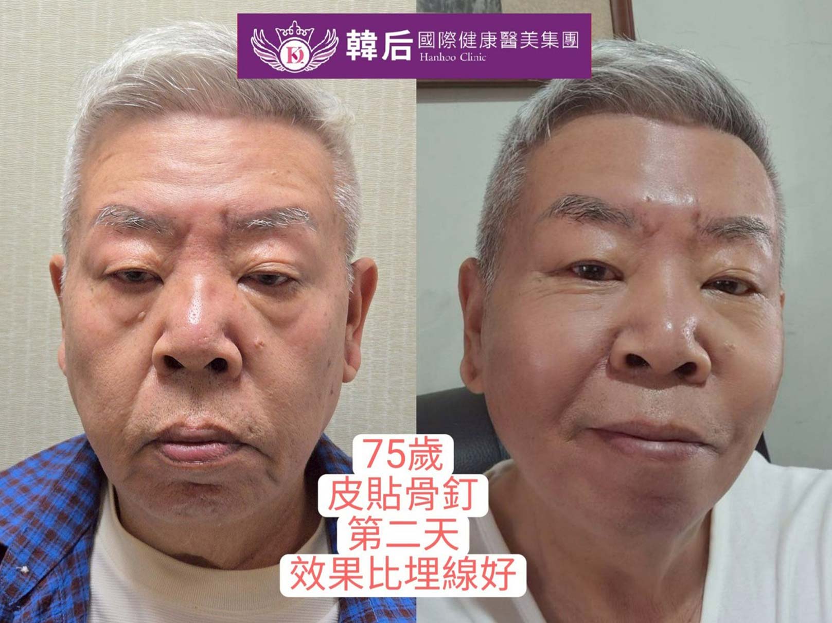 皮貼骨釘,筋膜復位,立即效果,貼平法令紋,拉提嘴邊肉,拉提緊緻,時尚小臉。韓后醫美