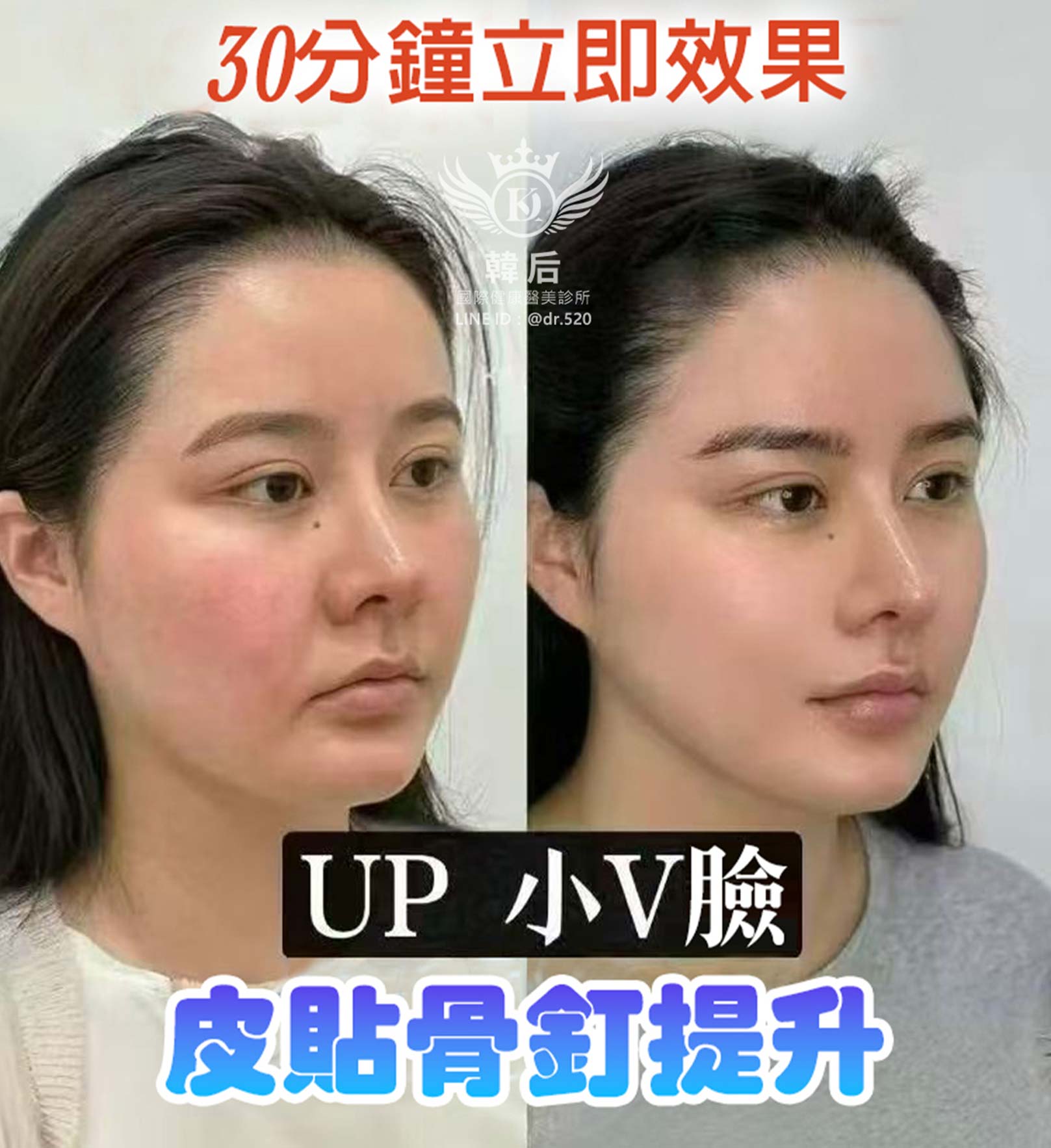 30分鐘立即效果,UP 小V臉,皮貼骨釘提升,拉提緊緻,時尚小臉。韓后醫美