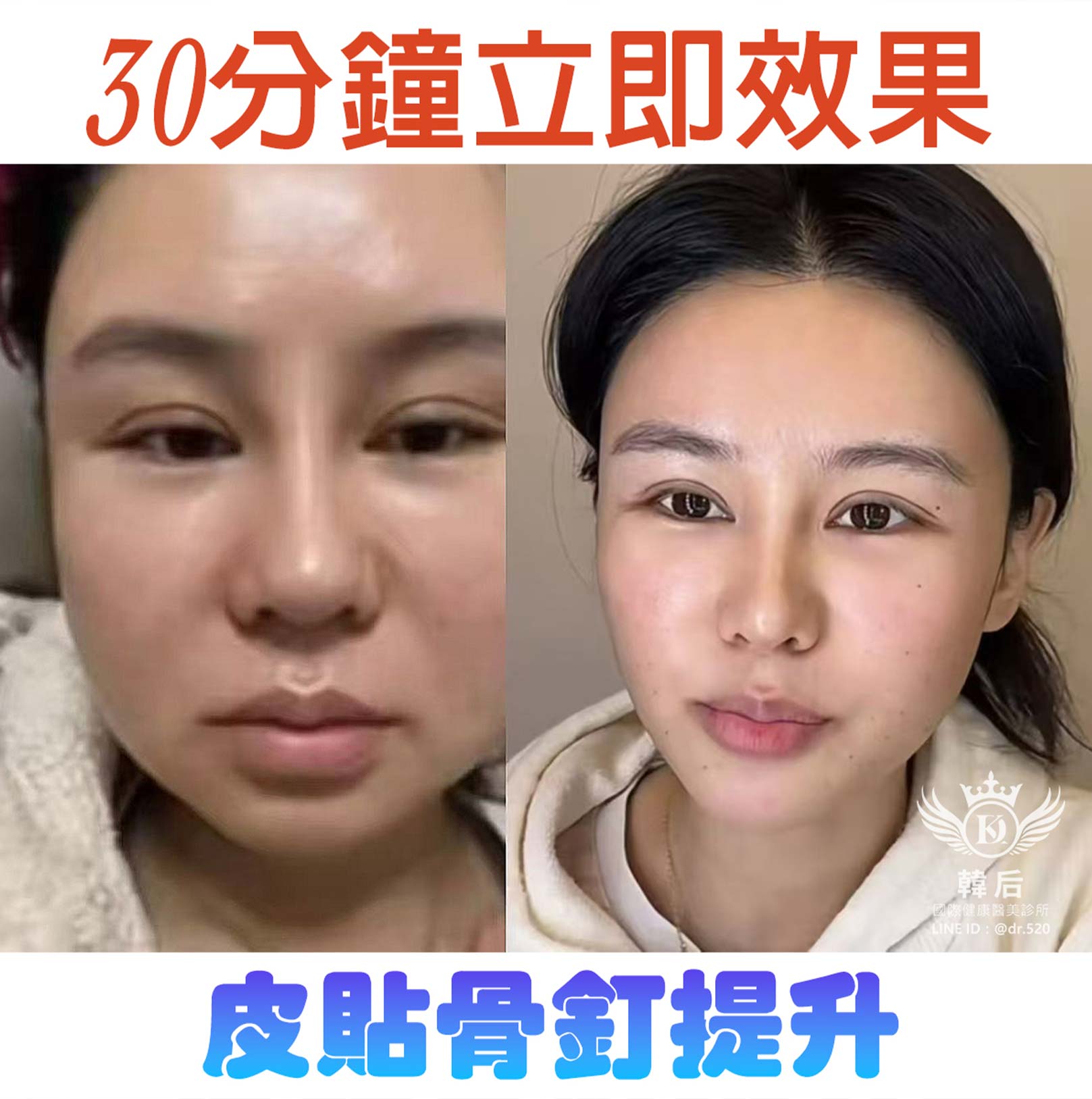 30分鐘立即效果,UP 小V臉,皮貼骨釘提升,拉提緊緻,時尚小臉。韓后醫美