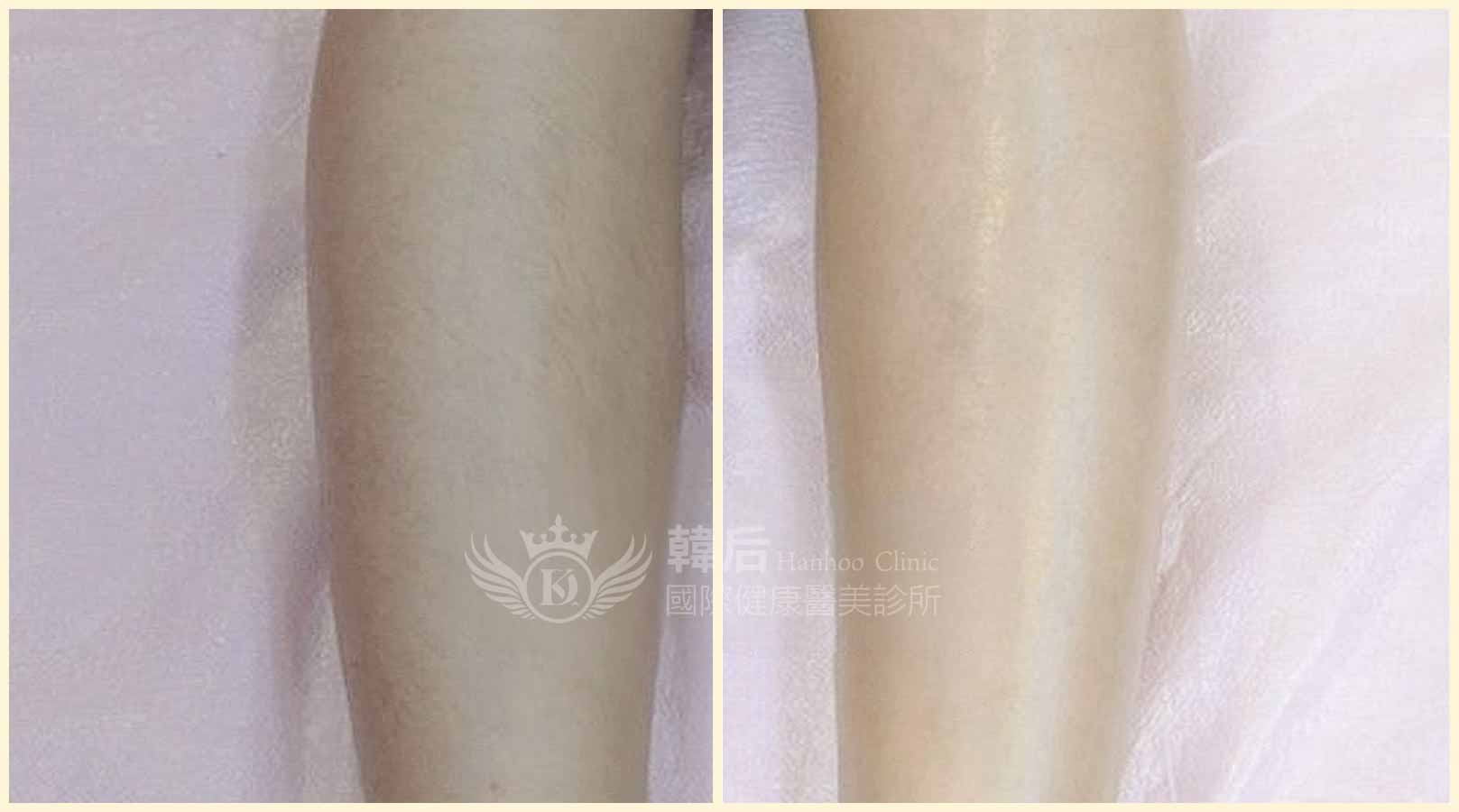 韓后醫美 脈衝光除毛 腿毛 素人真實案例