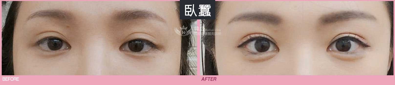 韓后醫美 玻尿酸作用於臥蠶 素人真實案例
