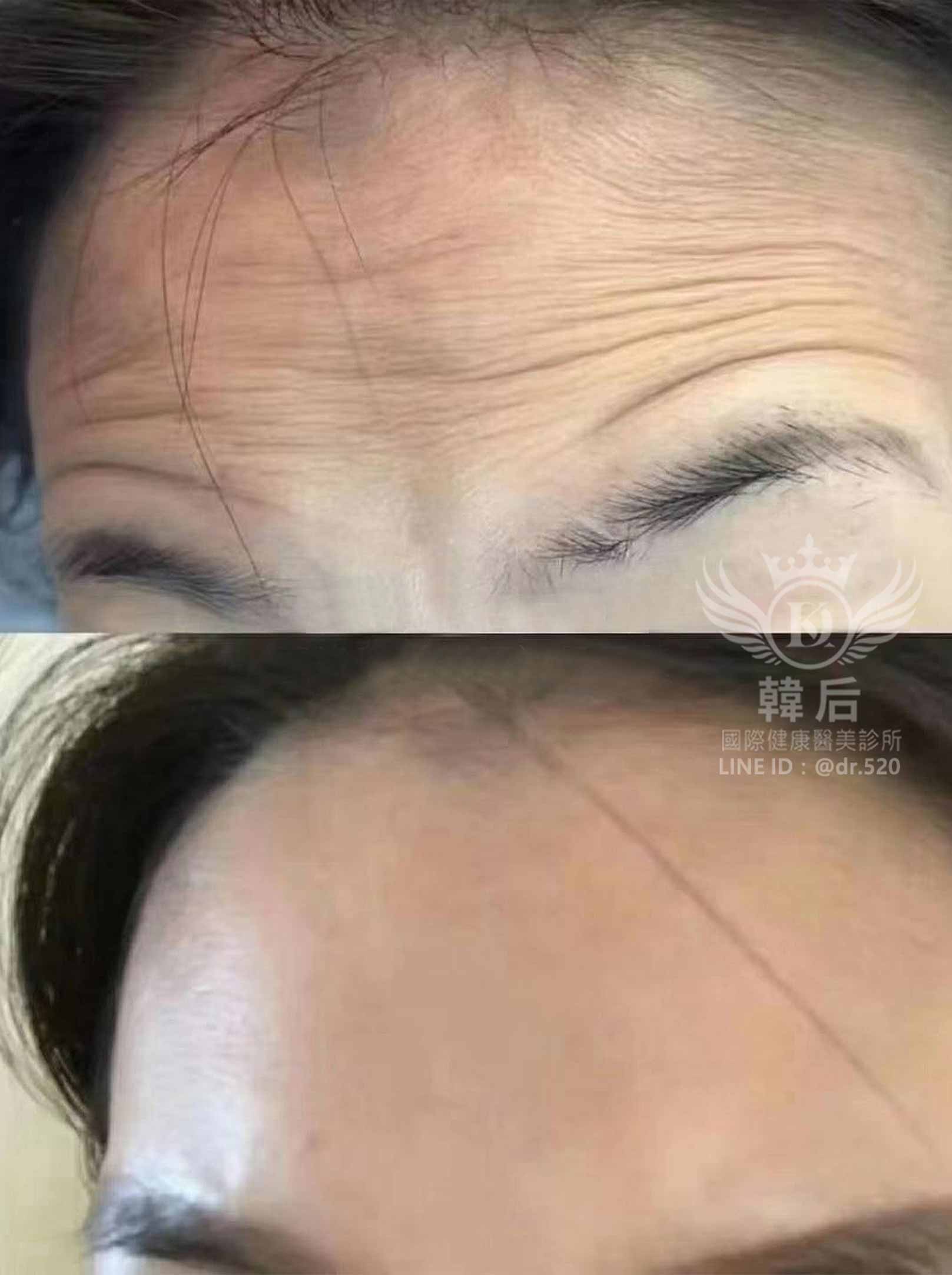 韓后醫美 肉毒 抬頭紋 素人真實案例